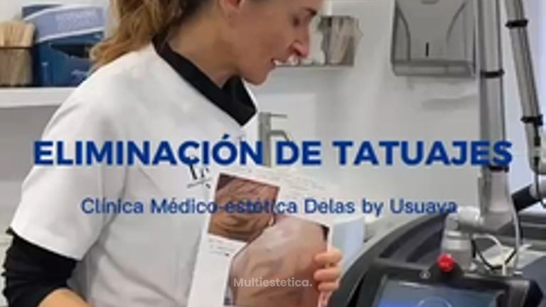 Clínica Delas - Eliminacion de tatuajes