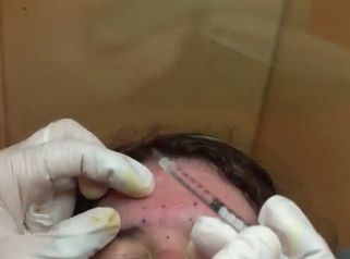 Todo lo que debes saber sobre la toxina botulínica