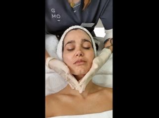 Rejuvenecimiento facial - Clínica Graziella Moraes