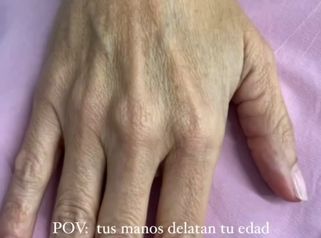 REJUVENECIMIENTO DE MANOS CON ÁCIDO HIALURÓNICO