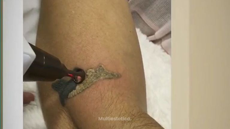 Borrado de tatuaje - Corpobel Medicina Estetica