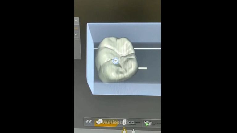 Creación de una Carilla Dental - Clínica Cabeceran