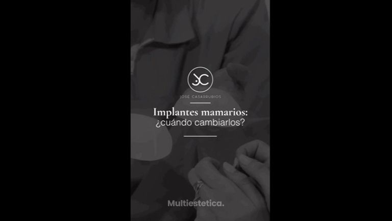 Cuando cambiar los implantes - Dr. Jose Casarrubios