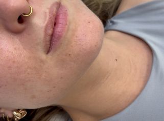 Labios Dra Sanchez - Clinicas Esquivel Valencia