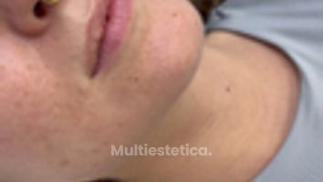 Labios Dra Sanchez - Clinicas Esquivel Valencia