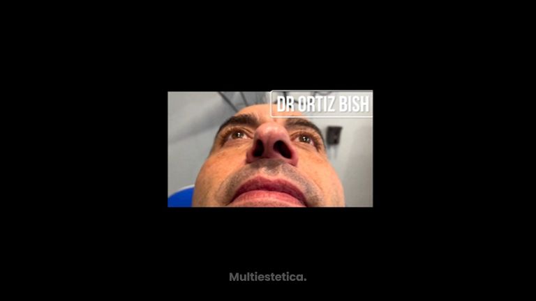 Rinoplastia - Dr Francisco Ortiz Bish