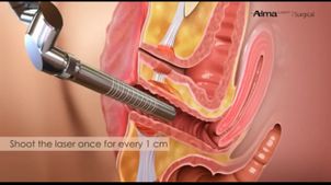 rejuvenecimiento vaginal con láser rejuvenecimiento vaginal con láser
