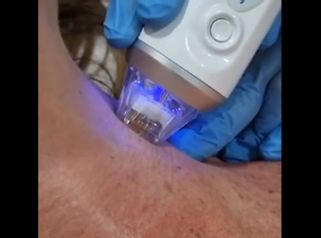 Radiofrecuencia facial - Dra. Alejandra Almenares
