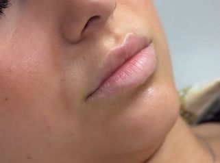 Aumento de labios - Clínica Opción Médica