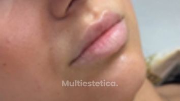 Aumento de labios - Clínica Opción Médica