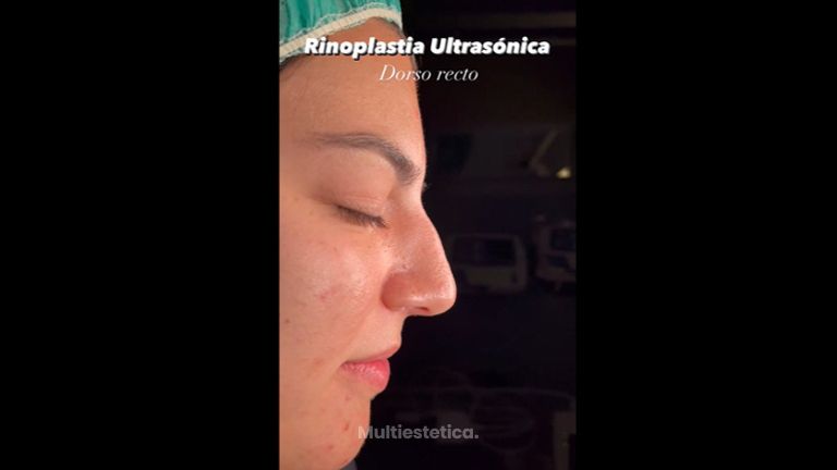 Rinoplastia - Dr. Alberto Candau