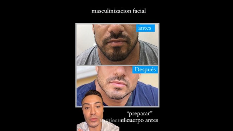 Masculinización facial - Dr. Roberto Ramírez