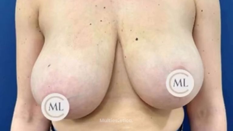 Reducción de pecho - Clínica Dr. Millán Longo y Asociados