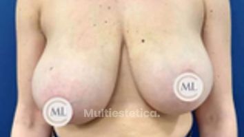 Reducción de pecho - Clínica Dr. Millán Longo y Asociados