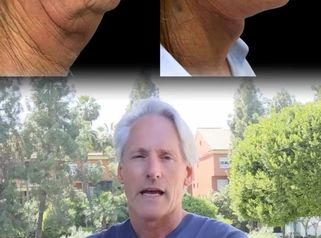 Hoy te cuento el caso de mi paciente. Apenas 10 días después de una cirugía de lifting facial