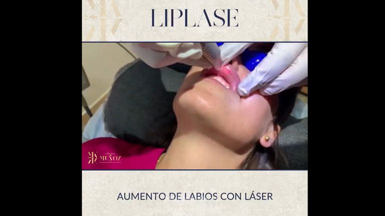 Aumento de labios - Clínica Dra. Muñoz