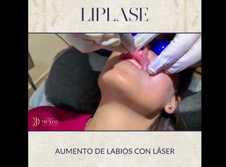 Aumento de labios - Clínica Dra. Muñoz
