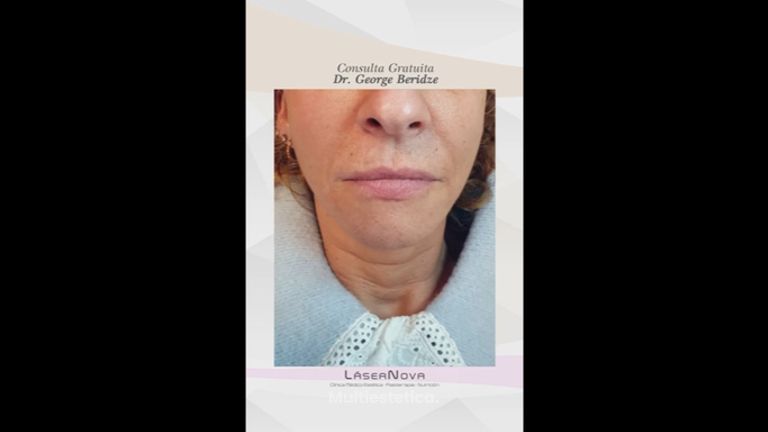 Rejuvenecimiento facial - Clínica Lasernova