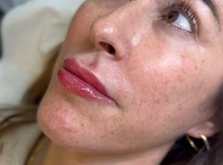 paciente contenta despues de los labios