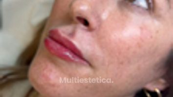 paciente contenta despues de los labios