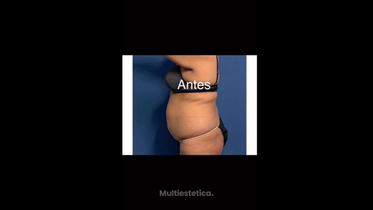 Abdominoplastia - Dr. Ruiz Montoya