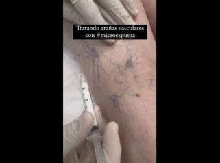 Varices - Clínica Dr. Carvajal