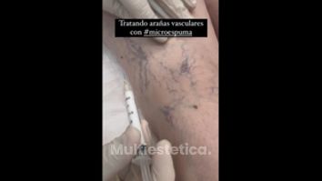 Varices - Clínica Dr. Carvajal