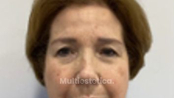 Blefaroplastia - Dr. Néstor Naranjo, Aevo