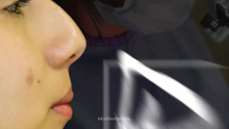 Rinoplastia Étnica Híbrida Ultrasónica