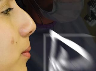 Rinoplastia Étnica Híbrida Ultrasónica