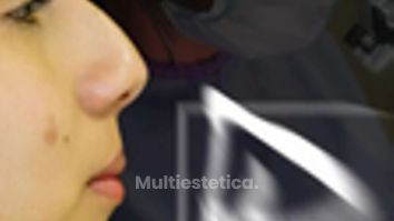 Rinoplastia Étnica Híbrida Ultrasónica