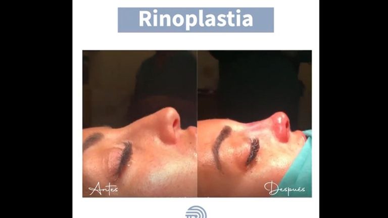 Rinoplastia - Clínica Pérez Espadero