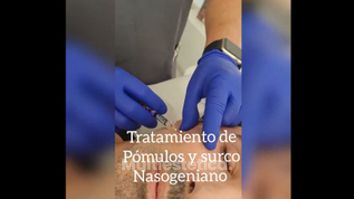 Aumento de pómulos +  Surcos nasogenianos - Clínica Fama