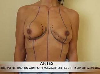 DOBLE SURCO Y DINAMISMO MUSCULAR TRAS UNA MAMOPLASTIA DE AUMENTO