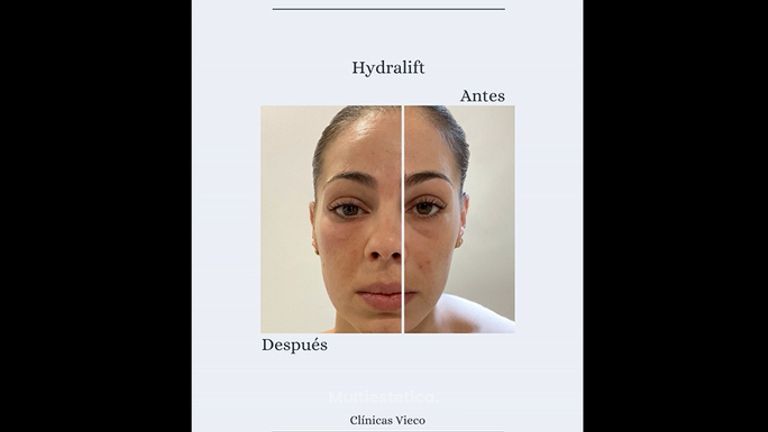 Hydralift - Clínicas Vieco