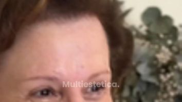 Blefaroplastia Láser 4 Párpados