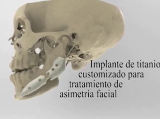 Tratamiento de asimetría facial 