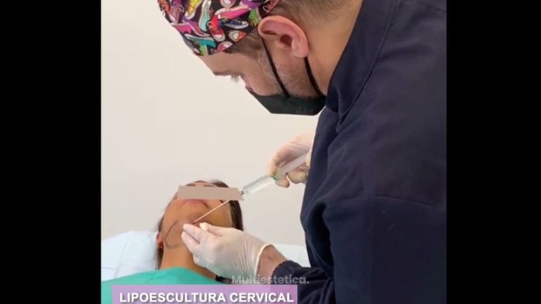 Liposucción Cervical - Clínica Freire