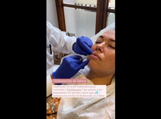 Aumento labios - Clinica Doctor Morano