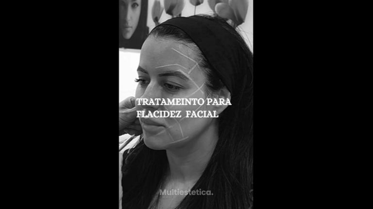 Flacidez facial - Clínica Amédic