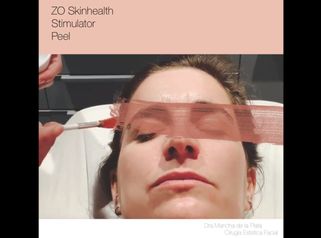 ZO Skinhealth Stimulator Peel es el peeling perfecto para iluminar tu piel para un evento.