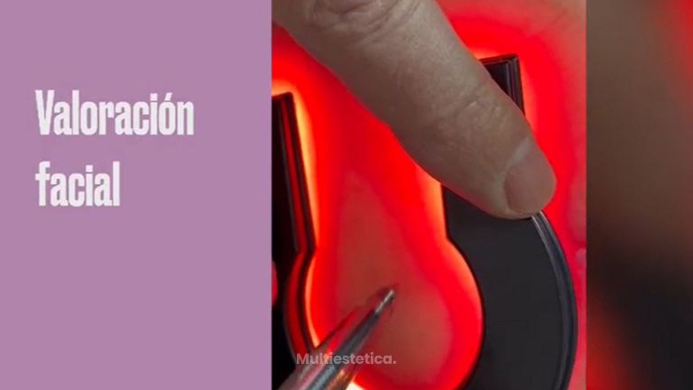 Clínica Lasernova- varices - arañas vasculares