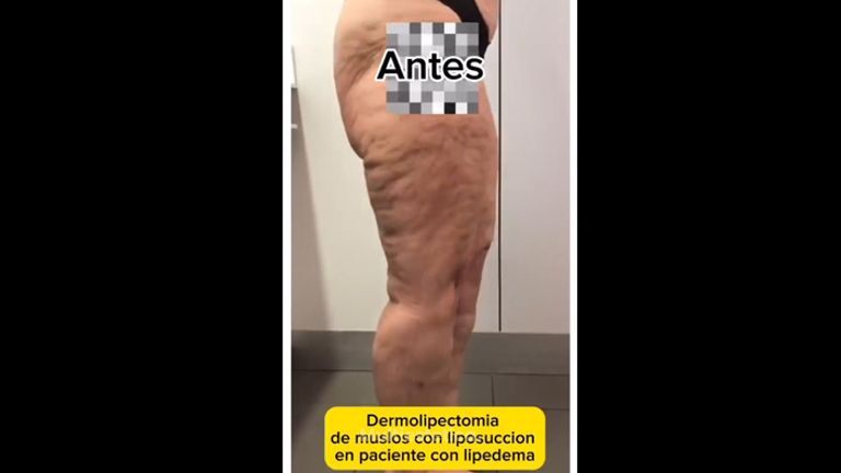 Dermolipectomía - Dra. Dolça López Munne