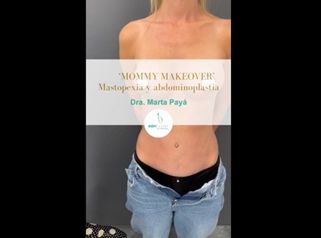 "MOMMY MAKEOVER" Mastopexia y abdominoplastia - Dra. Marta Payá