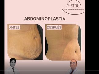 Abdominoplastia 