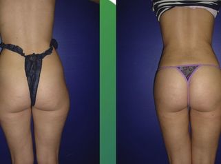 Lipoescultura definitivo