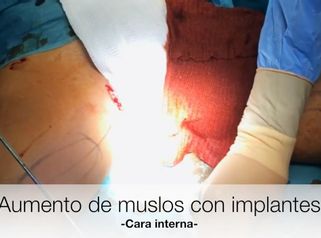Aumento muslos con implantes