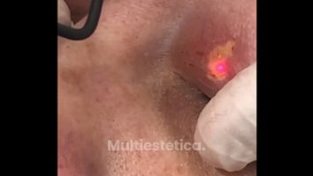 Eliminación de xantelasmas