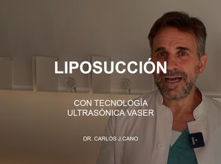 Liposucción con tecnología ultrasónica VASER -  Clínica Tufet