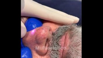 Arañas vasculares - Clínica Dra. Muñoz